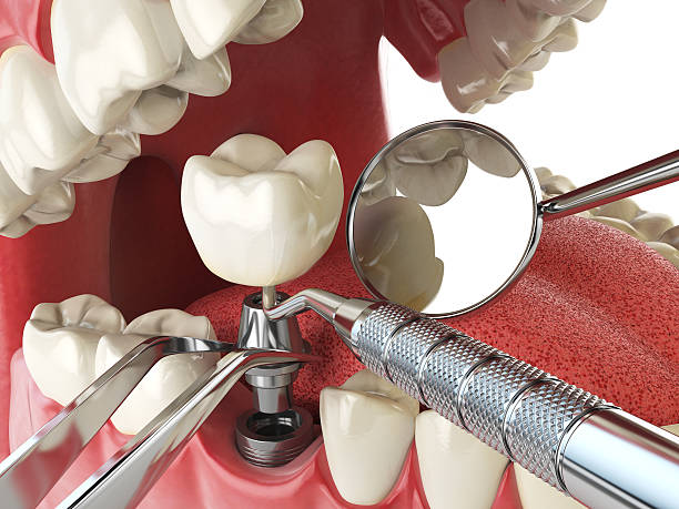Best Chipped Tooth Repair Near Me  in Fabrica, TX